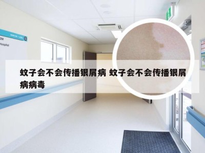 蚊子会不会传播银屑病 蚊子会不会传播银屑病病毒