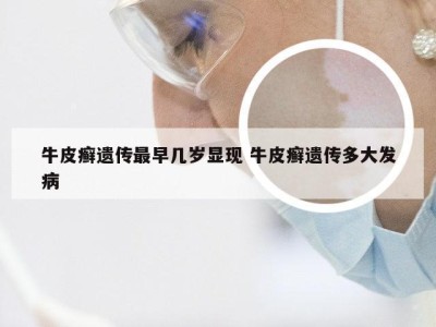 牛皮癣遗传最早几岁显现 牛皮癣遗传多大发病
