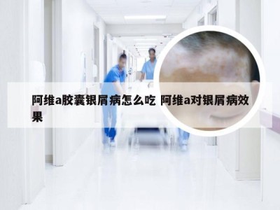 阿维a胶囊银屑病怎么吃 阿维a对银屑病效果