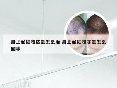 身上起红嘎达是怎么治 身上起红嘎子是怎么回事