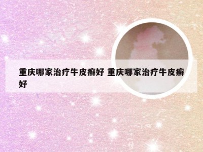 重庆哪家治疗牛皮癣好 重庆哪家治疗牛皮癣好