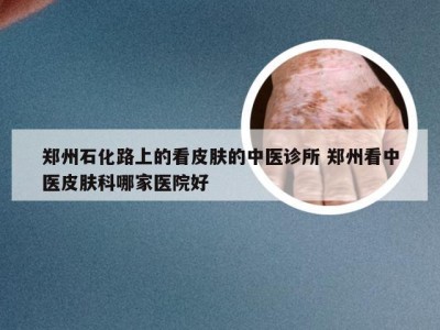 郑州石化路上的看皮肤的中医诊所 郑州看中医皮肤科哪家医院好