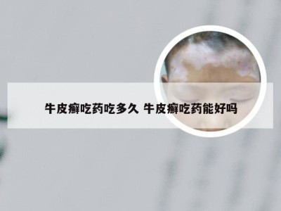 牛皮癣吃药吃多久 牛皮癣吃药能好吗