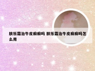 肤乐霜治牛皮癣癣吗 肤乐霜治牛皮癣癣吗怎么用