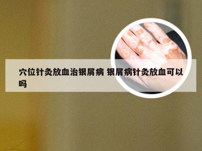穴位针灸放血治银屑病 银屑病针灸放血可以吗