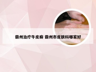 霸州治疗牛皮癣 霸州市皮肤科哪家好