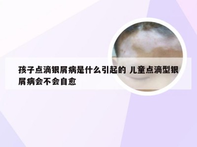 孩子点滴银屑病是什么引起的 儿童点滴型银屑病会不会自愈