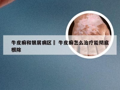 牛皮癣和银屑病区別 牛皮癣怎么治疗能彻底根除