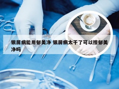 银屑病能用郁美净 银屑病太干了可以擦郁美净吗
