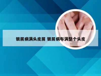 银屑病满头皮屑 银屑病布满整个头皮