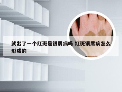 就出了一个红斑是银屑病吗 红斑银屑病怎么形成的