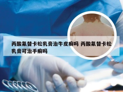 丙酸氟替卡松乳膏治牛皮癣吗 丙酸氟替卡松乳膏可治手癣吗