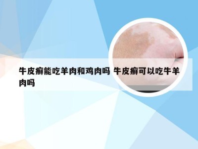 牛皮癣能吃羊肉和鸡肉吗 牛皮癣可以吃牛羊肉吗