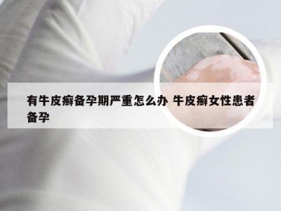 有牛皮癣备孕期严重怎么办 牛皮癣女性患者备孕