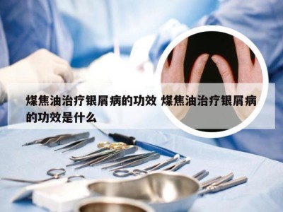 煤焦油治疗银屑病的功效 煤焦油治疗银屑病的功效是什么