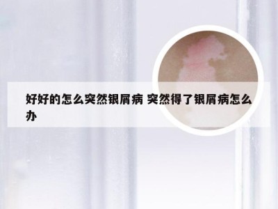 好好的怎么突然银屑病 突然得了银屑病怎么办