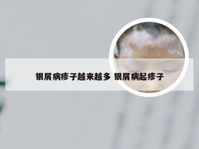 银屑病疹子越来越多 银屑病起疹子