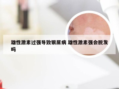 雄性激素过强导致银屑病 雄性激素强会脱发吗