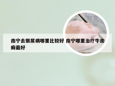 南宁去银屑病哪里比较好 南宁哪里治疗牛皮癣最好