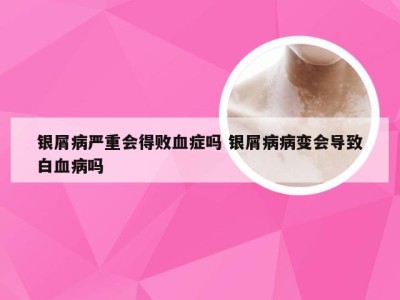 银屑病严重会得败血症吗 银屑病病变会导致白血病吗