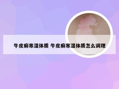 牛皮癣寒湿体质 牛皮癣寒湿体质怎么调理