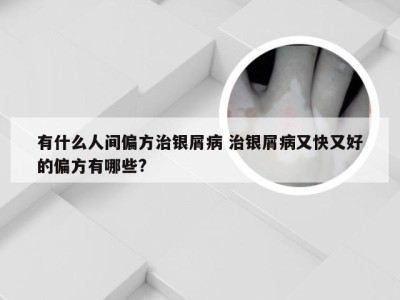 有什么人间偏方治银屑病 治银屑病又快又好的偏方有哪些?