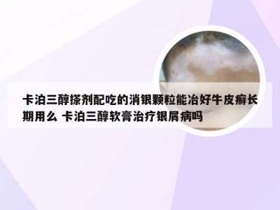 卡泊三醇搽剂配吃的消银颗粒能冶好牛皮癣长期用么 卡泊三醇软膏治疗银屑病吗