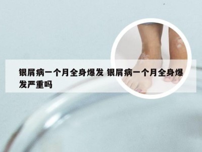 银屑病一个月全身爆发 银屑病一个月全身爆发严重吗
