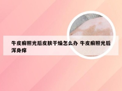 牛皮癣照光后皮肤干燥怎么办 牛皮癣照光后浑身痒