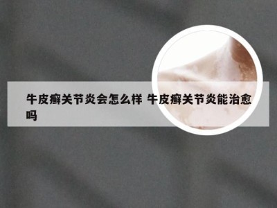 牛皮癣关节炎会怎么样 牛皮癣关节炎能治愈吗