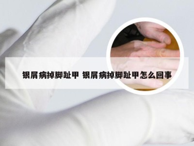银屑病掉脚趾甲 银屑病掉脚趾甲怎么回事