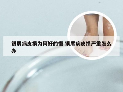 银屑病皮损为何好的慢 银屑病皮损严重怎么办