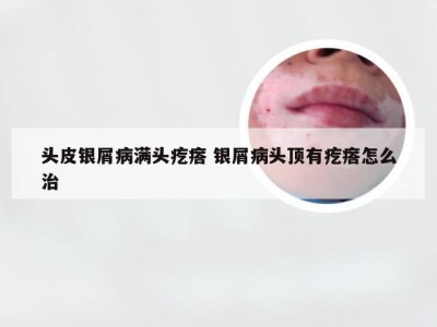 头皮银屑病满头疙瘩 银屑病头顶有疙瘩怎么治