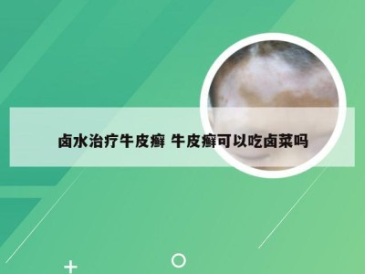 卤水治疗牛皮癣 牛皮癣可以吃卤菜吗