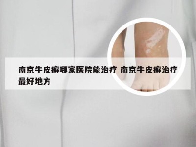 南京牛皮癣哪家医院能治疗 南京牛皮癣治疗最好地方