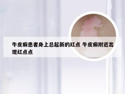 牛皮癣患者身上总起新的红点 牛皮癣附近出现红点点
