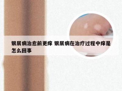 银屑病治愈前更痒 银屑病在治疗过程中痒是怎么回事