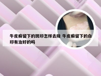 牛皮癣留下的斑印怎样去除 牛皮癣留下的白印有治好的吗