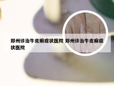 郑州诊治牛皮癣症状医院 郑州诊治牛皮癣症状医院