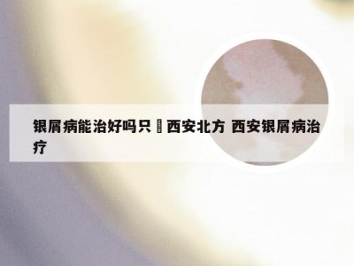 银屑病能治好吗只來西安北方 西安银屑病治疗