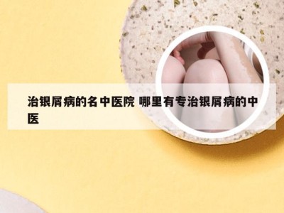 治银屑病的名中医院 哪里有专治银屑病的中医