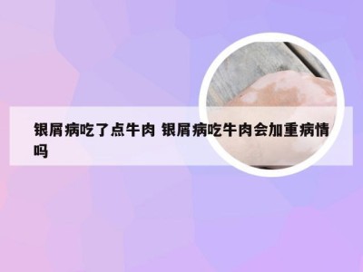 银屑病吃了点牛肉 银屑病吃牛肉会加重病情吗