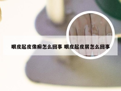 眼皮起皮像癣怎么回事 眼皮起皮屑怎么回事