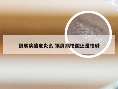 银屑病酸皮炎么 银屑病怕酸还是怕碱