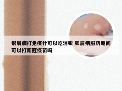 银屑病打免疫针可以吃消银 银屑病服药期间可以打新冠疫苗吗