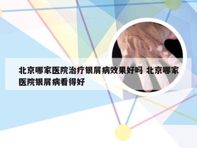 北京哪家医院治疗银屑病效果好吗 北京哪家医院银屑病看得好