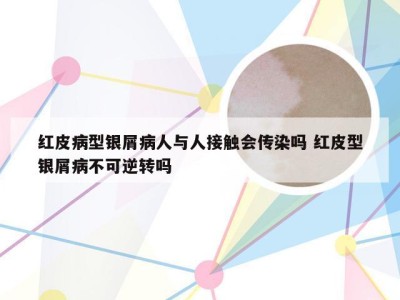 红皮病型银屑病人与人接触会传染吗 红皮型银屑病不可逆转吗