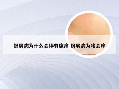 银屑病为什么会伴有瘙痒 银屑病为啥会痒