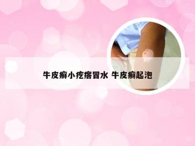 牛皮癣小疙瘩冒水 牛皮癣起泡