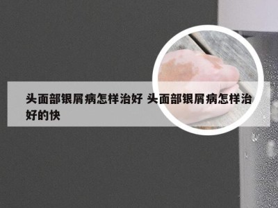头面部银屑病怎样治好 头面部银屑病怎样治好的快